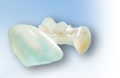 Inlays und Veneers